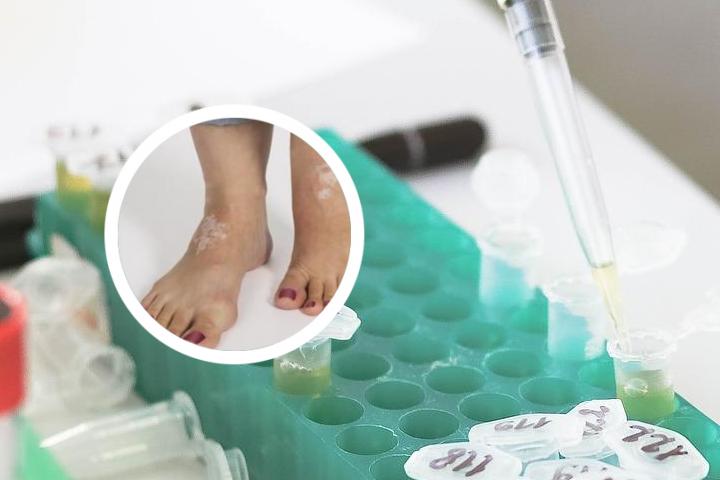 白癜风药物怎么样涂