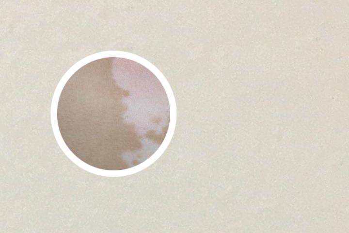 白癜风可以吃鳄龟吗