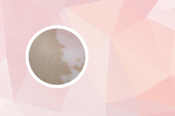 腿上白癜风和老年白斑区别