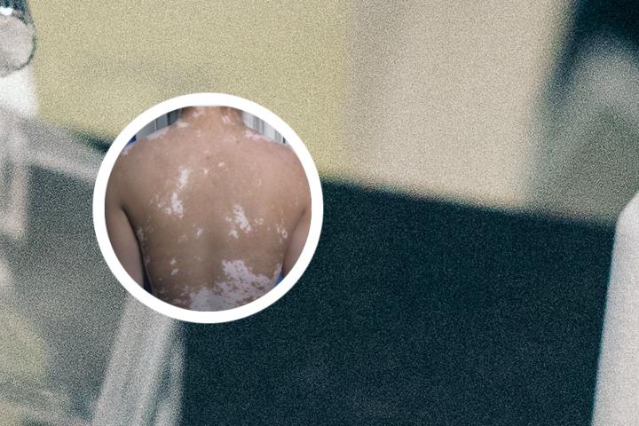 验血能看出白癜风吗
