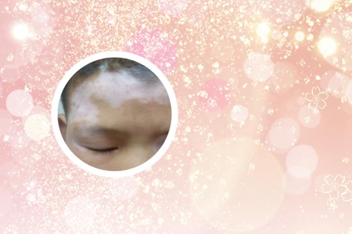 白癜风症状拟博润