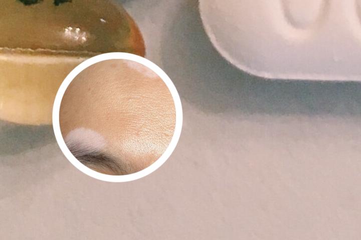 白癜风患者能吃醋泡花生吗