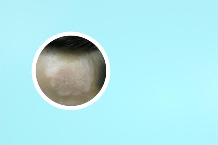 白癜风医院洗纹身咋样