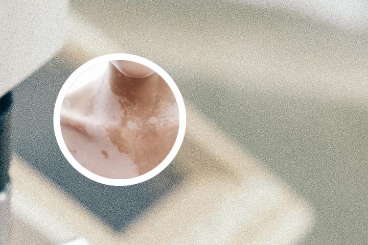 舒坦明软膏治白癜风