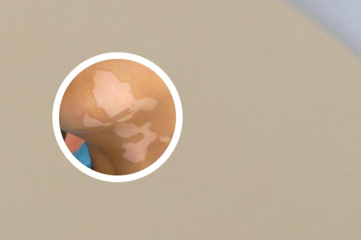 广东白癜风的最新治疗方法