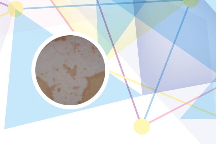 手心里有白癜风图片