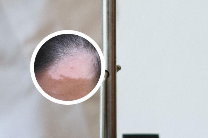 白癜风维生素e涂脸功效