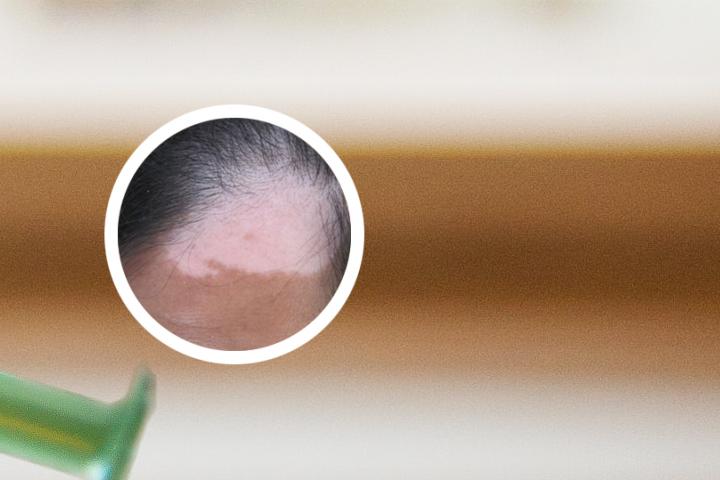 怎么避免白癜风扩大