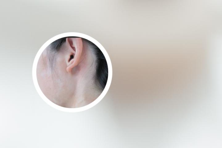 西宁看白癜风咋办