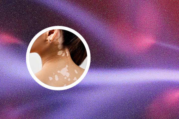 白癜风抹药后白斑周围发红
