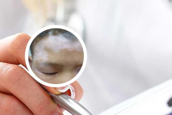 萌尔夫治白癜风
