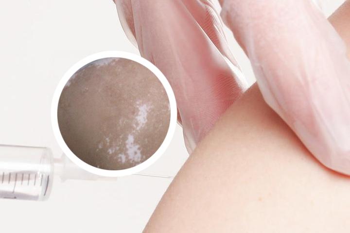 白家军白癜风
