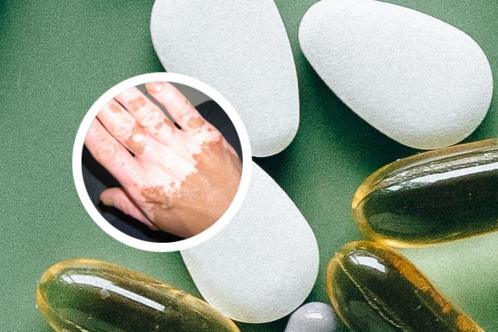 马东来治白癜风好
