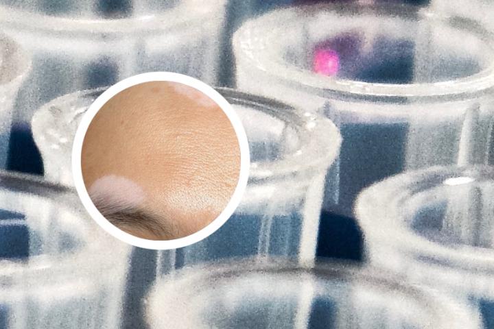 白癜风王振英 白癜风病的主要原因