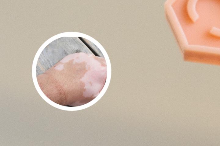 桃子白癜风能吃吗