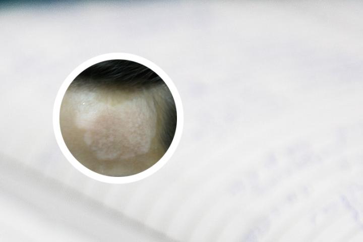 营养缺失的白癜风怎么治疗
