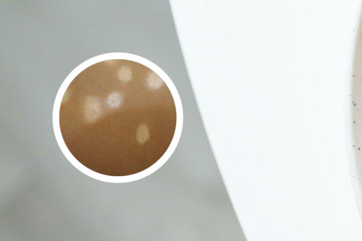 家里人都没有白癜风