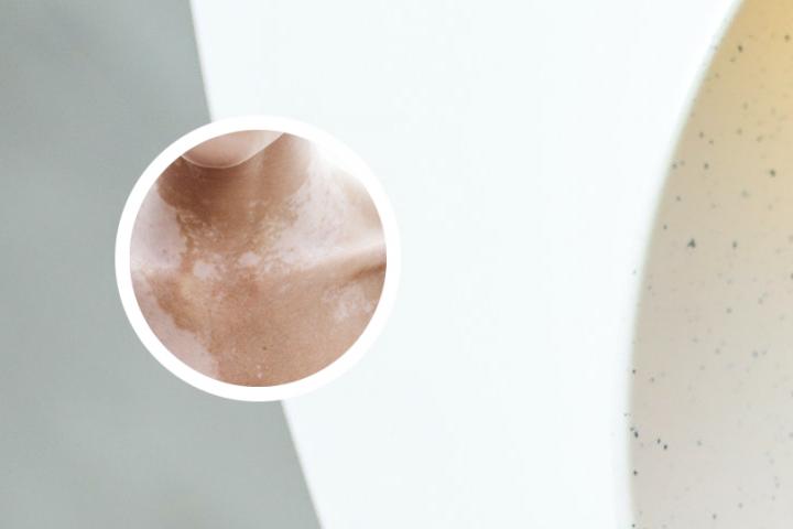 白癜风光疗后变粉红色