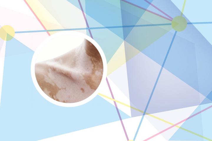 生长因子可以治疗白癜风吗