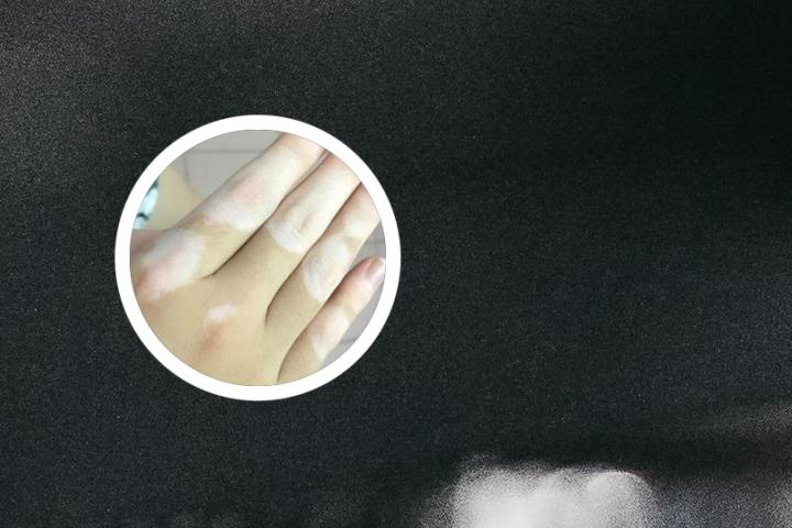 沈阳治疗白癜风那里专科好