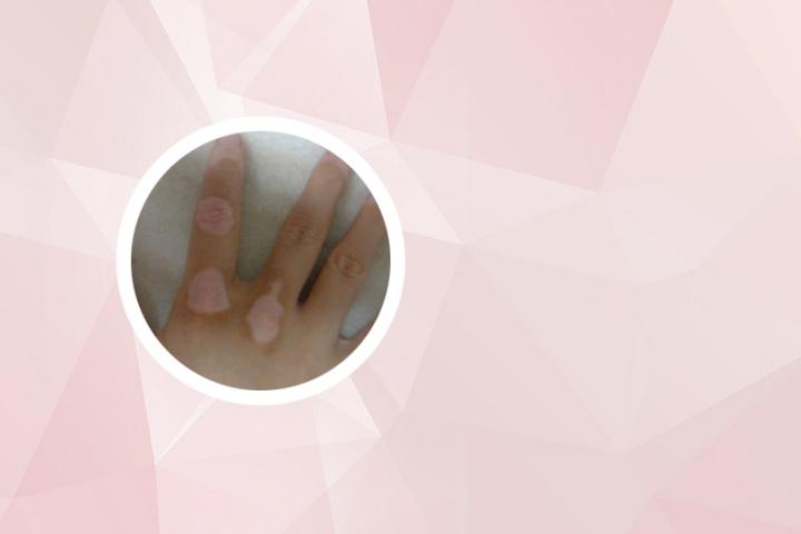 苏州杭州上海治疗白癜风