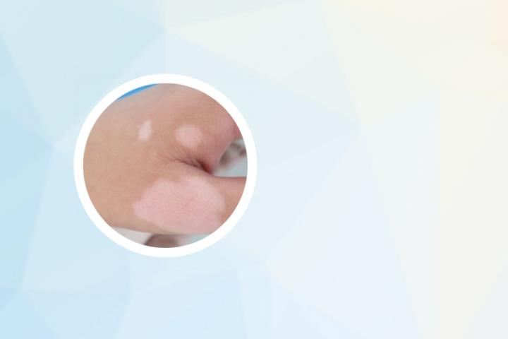 夏季白癜风为什么扩散
