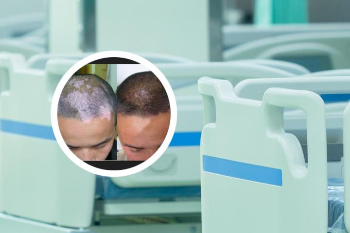 鸭蛋籽治疗白癜风怎么用