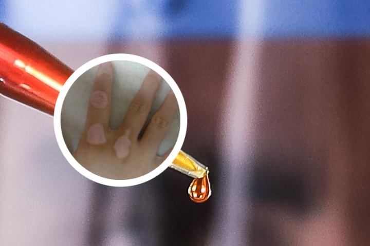 临邑县个人治疗白癜风