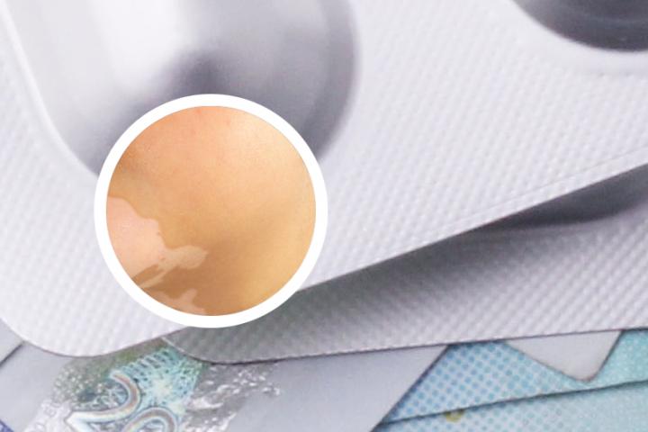 白癜风治疗后长出小黑点