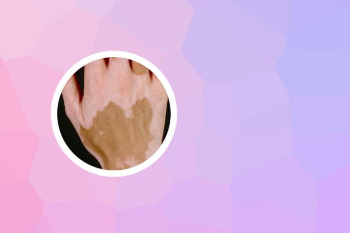 白癜风所需的维生素