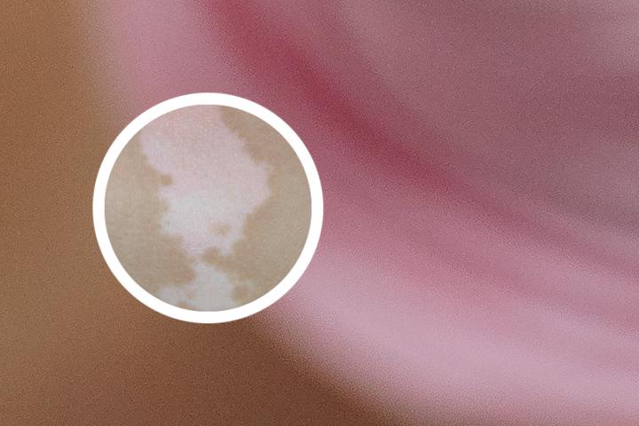 白癜风患者能吃辣吗