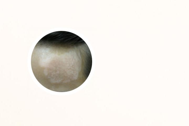 内蒙去哪里看白癜风好