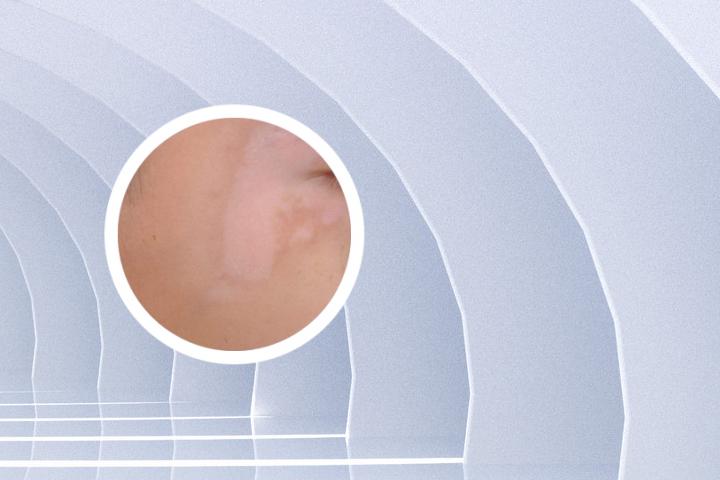散发型白癜风的分型