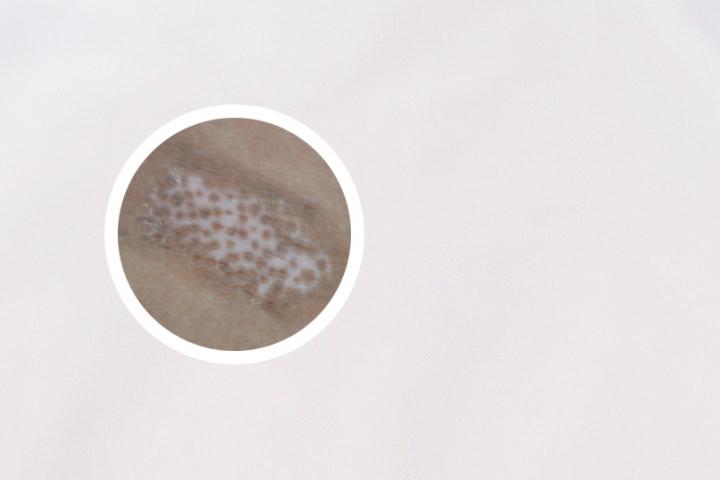 生石灰治疗白癜风